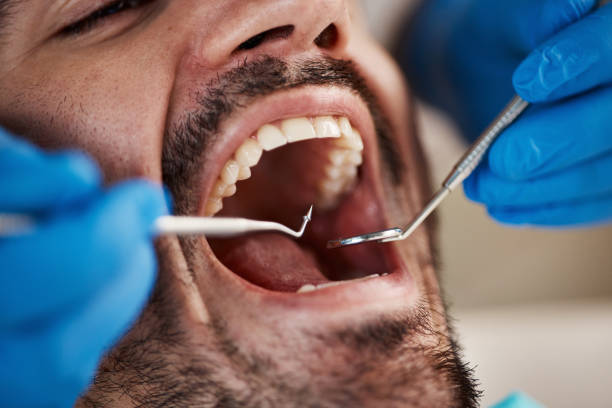 Best Emergency Dentist for Lost Fillings or Crowns in Greer, SC